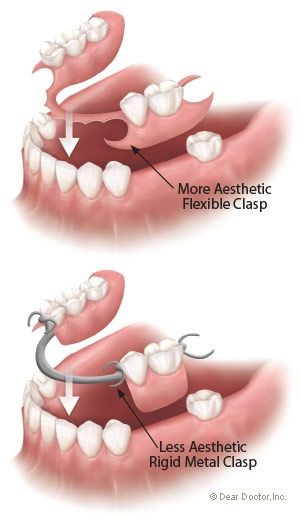 Porcelain Dentures Evansville IN 47701